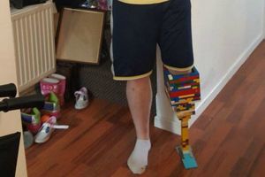 Joven fabrica una 'pierna de Lego' para concientizar sobre la diabetes