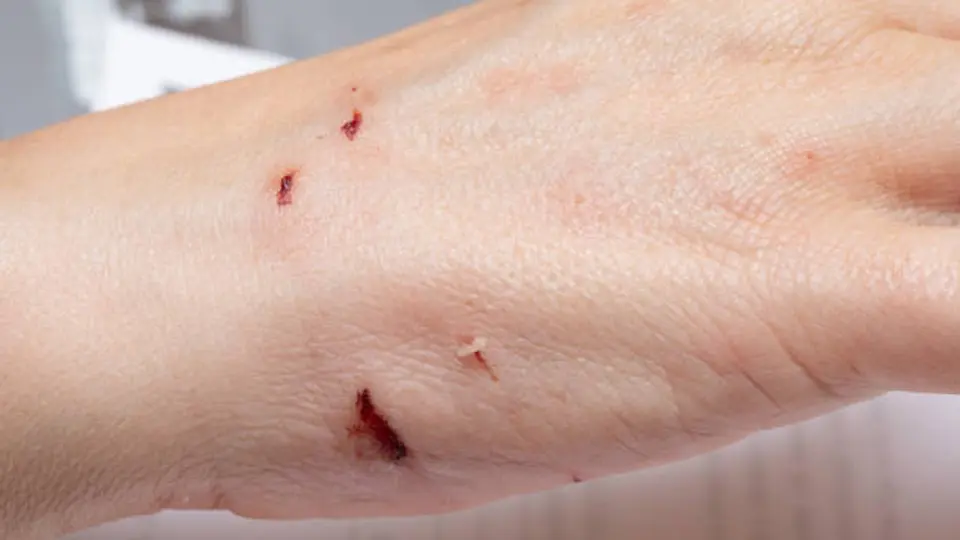 La atención médica inmediata tras una mordedura reduce significativamente el riesgo de complicaciones. / iStock