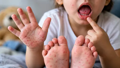 ¿Cuáles son los síntomas del Coxsackie? Detectan seis casos en niños de Guadalajara