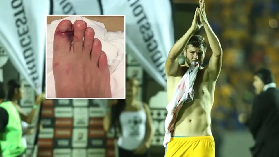 Gignac comparte imagen de golpe en dedo