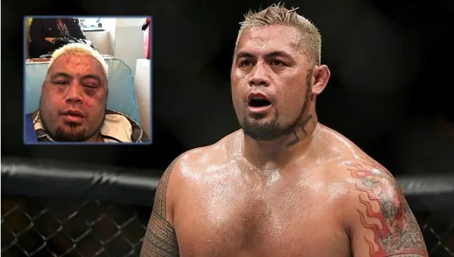Peleador de UFC muestra su rostro tras brutal golpiza