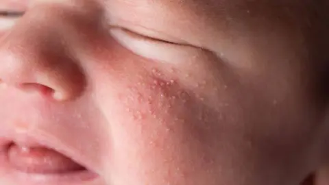 El sarampión es una enfermedad altamente contagiosa que puede provocar complicaciones graves, especialmente en menores no vacunados. / iStock