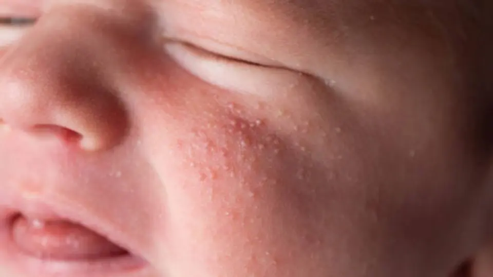 El sarampión es una enfermedad altamente contagiosa que puede provocar complicaciones graves, especialmente en menores no vacunados. / iStock