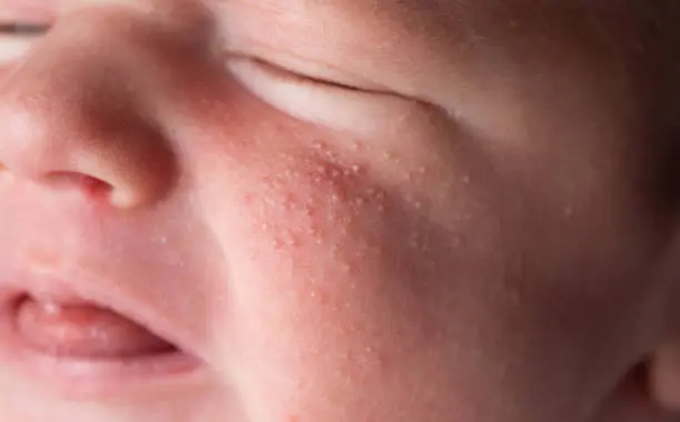 El sarampión es una enfermedad altamente contagiosa que puede provocar complicaciones graves, especialmente en menores no vacunados. / iStock