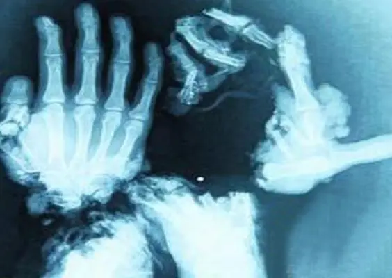 Tras accidente se vuelve 'Cangrejo Humano'