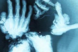 Tras accidente se vuelve 'Cangrejo Humano'