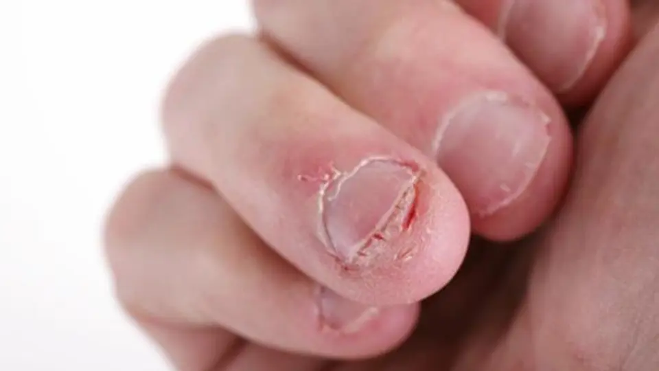 Pierde la vida... por morderse las uñas