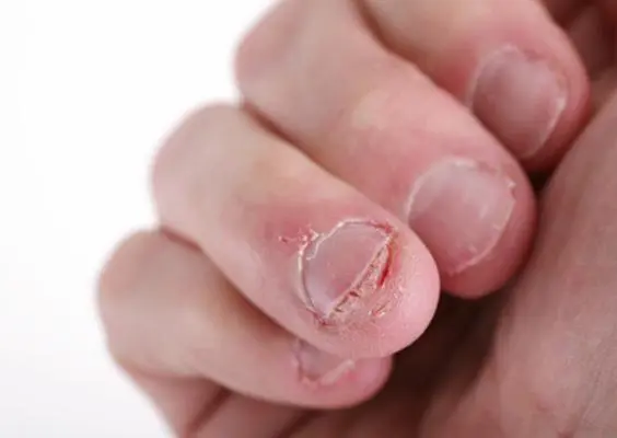 Pierde la vida... por morderse las uñas
