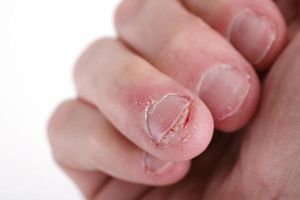 Pierde la vida... por morderse las uñas