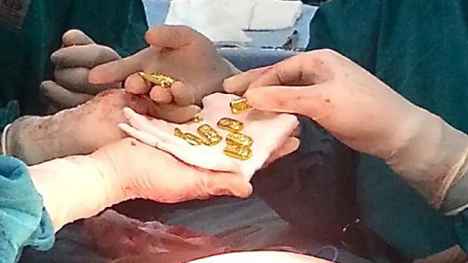 Hombre tenía doce barras de oro en el estómago