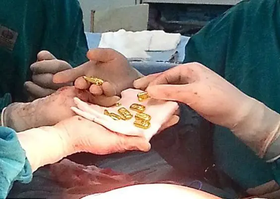 Hombre tenía doce barras de oro en el estómago