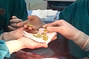 Hombre tenía doce barras de oro en el estómago