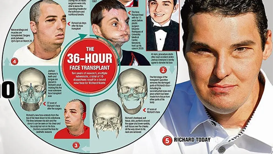 El transplante de cara más extenso del mundo