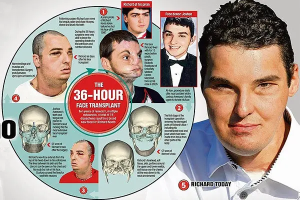 El transplante de cara más extenso del mundo
