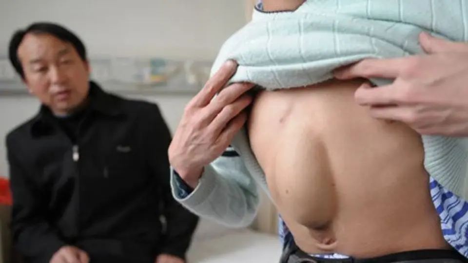 Joven chino vivió 24 años con el corazón en el estómago