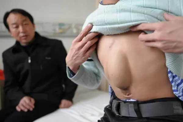 Joven chino vivió 24 años con el corazón en el estómago