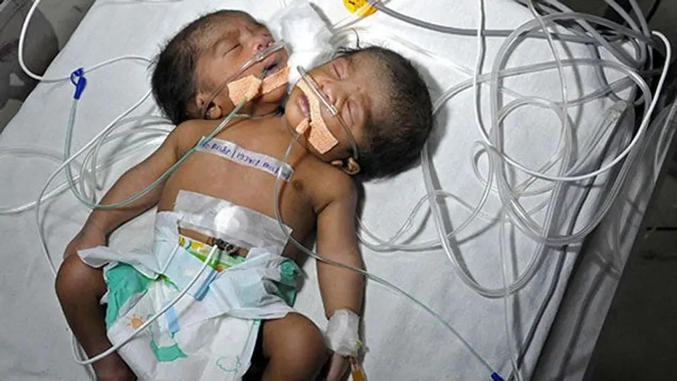 Nace el tercer niño de dos cabezas en India