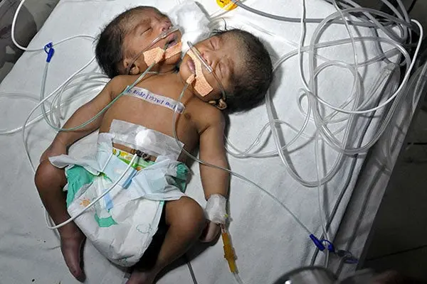 Nace el tercer niño de dos cabezas en India