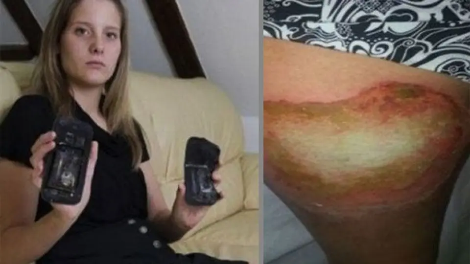 Joven sufre quemaduras por explosión de su celular en una pierna