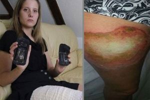 Joven sufre quemaduras por explosión de su celular en una pierna
