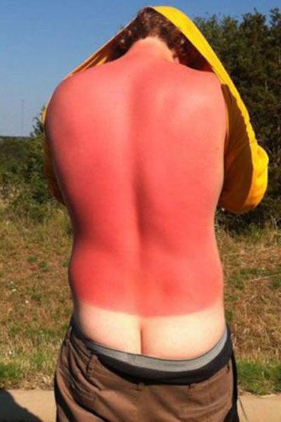 Un hombre se baja los pantalones para mostrar la diferencia de color en la espalda | ESPECIAL