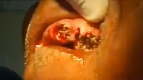 Dentista encuentra gusanos en encías de paciente