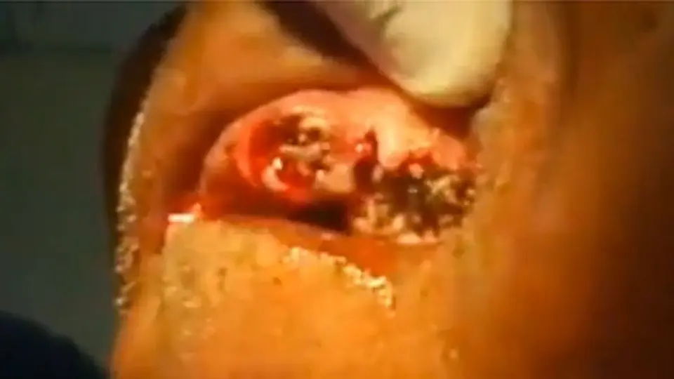 Dentista encuentra gusanos en encías de paciente