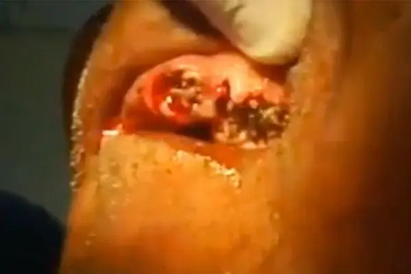 Dentista encuentra gusanos en encías de paciente