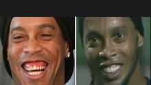 Así quedó Ronaldinho tras cirugía estética dental