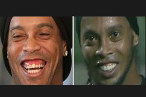 Así quedó Ronaldinho tras cirugía estética dental