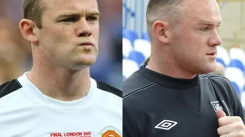 Rooney se sometió a un segundo transplante de cabello