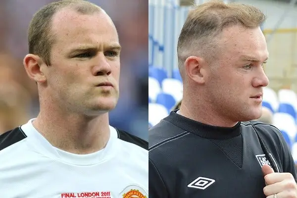 Rooney se sometió a un segundo transplante de cabello