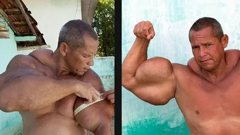 Hombre brasileño es el 'Popeye Humano'