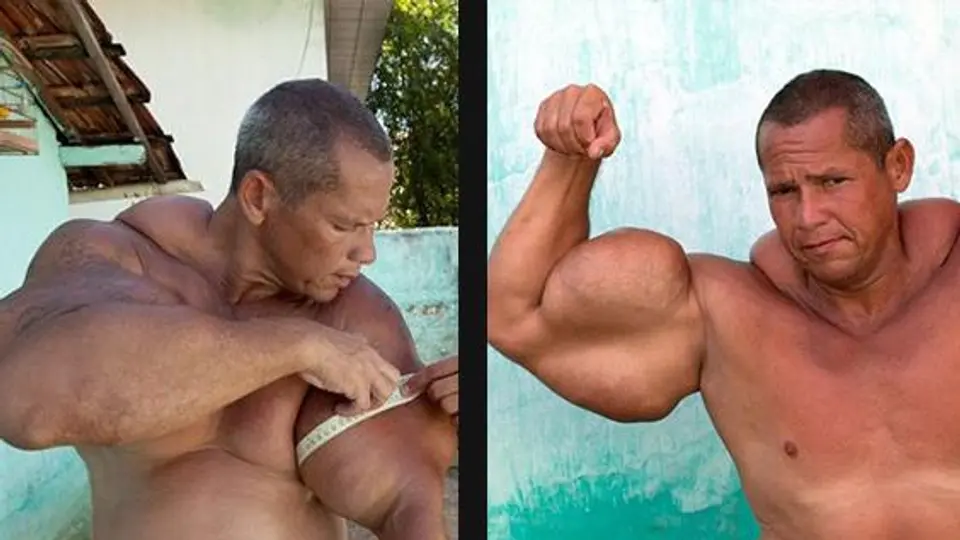 Hombre brasileño es el 'Popeye Humano'