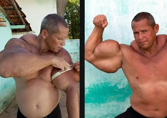 Hombre brasileño es el 'Popeye Humano'