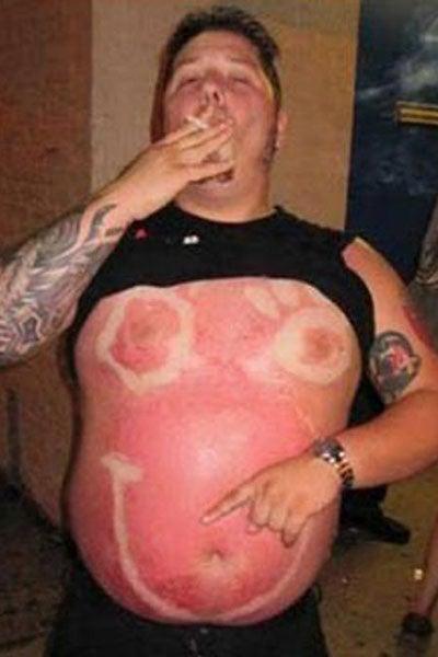 Este hombre parece contento de mostrar su abdomen quemado | ESPECIAL