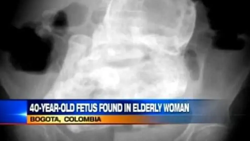Colombiana de 82 años descubre que tiene feto de 40