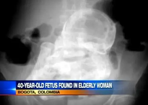 Colombiana de 82 años descubre que tiene feto de 40