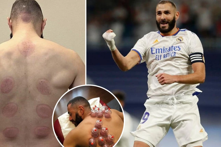 What is 'hijama' and why is Karim Benzema a fan of it?