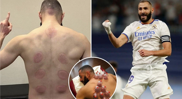 What is 'hijama' and why is Karim Benzema a fan of it?