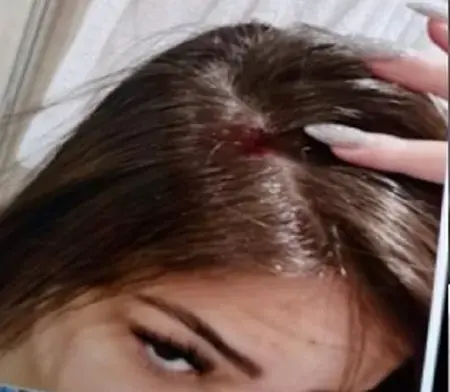 Gabriella Cavallin’s injury from one of the alleged incidents | UOL