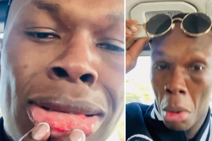 Adesanya then took to social media to show off his black eye - Image Credit - Stylebender/Instagram