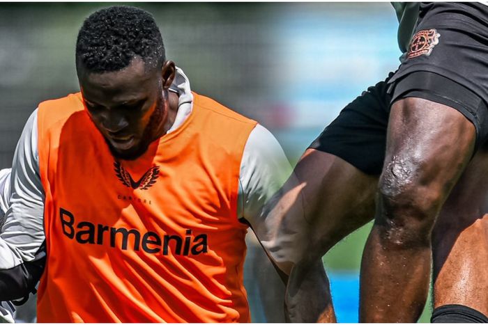 Victor Boniface shows off horror scars from surgery.