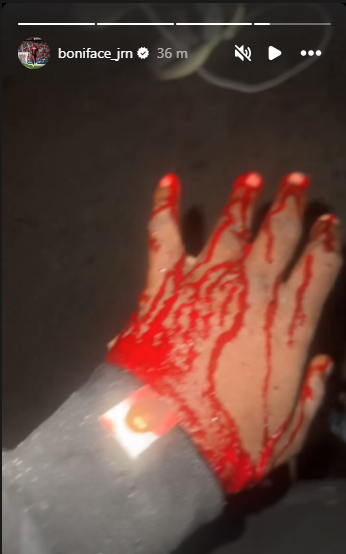 Victor Boniface's car crash injuries | Instagram