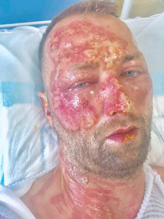 Bývalý švédsky hokejový útočník Kristian Huselius utrpel vážne popáleniny tváre a ramena.