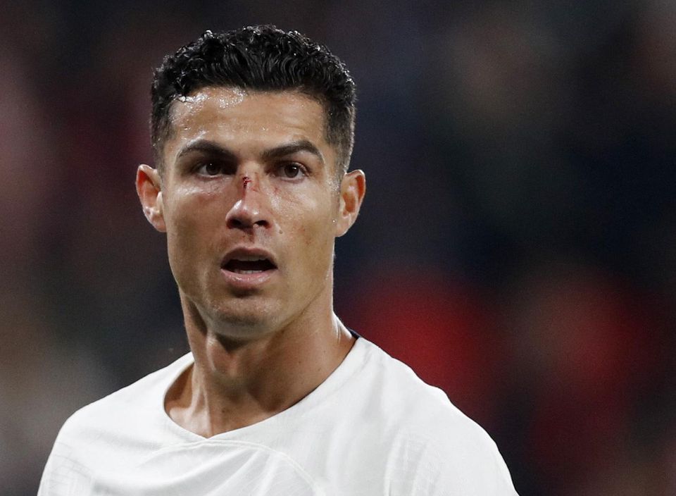 Cristiano Ronaldo so zraneným nosom
