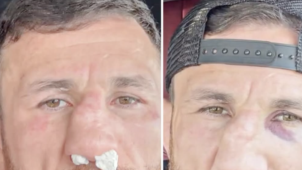 Мераб Двалишвили отново със счупен нос