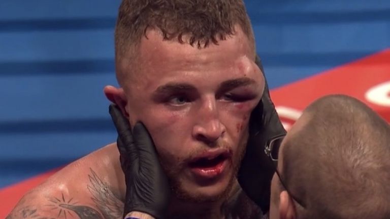 Огромна подутина на око спря първия двубой от боксовата галавечер в Манчестър