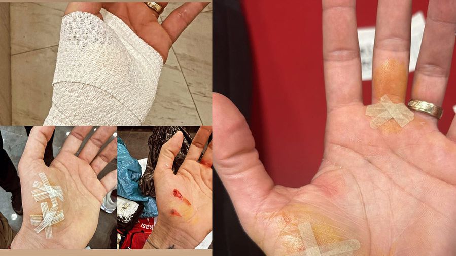 Това боли! Два пирона се забиха в ръката на Османи Хуанторена по време на финал №3 в Турция