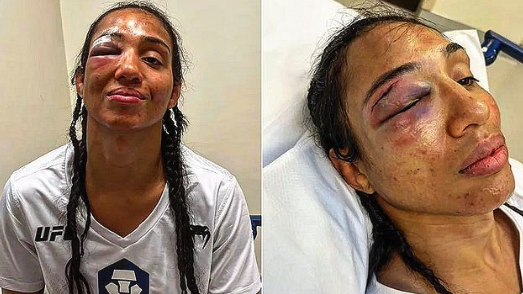 Тайла Сантос ще се оперира заради счупена орбиталната кост